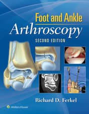 Foot & Ankle Arthroscopy