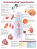 Understanding Hypertension Anatomical Chart