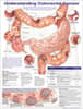 Understanding Colorectal  Cancer Anatomical Chart