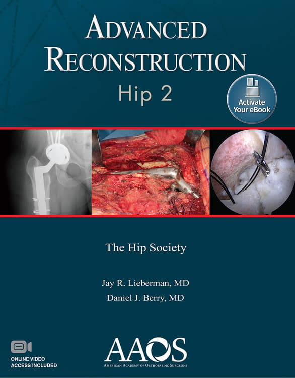Advanced Reconstruction: Hip 2: Ebook without Multimedia