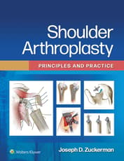 Shoulder Arthroplasty