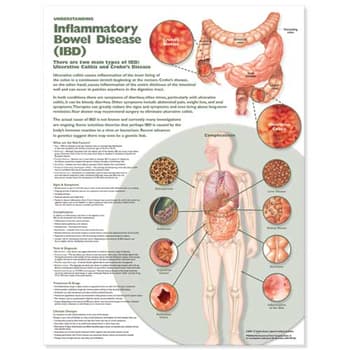 Understanding Inflammatory Bowel Disease (IBD) Anatomical Chart