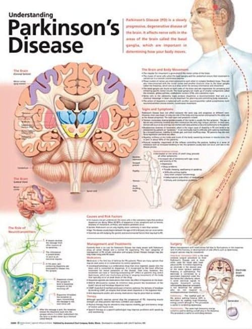 Understanding Parkinson's Disease Anatomical Chart