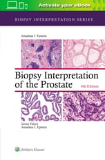 Biopsy Interpretation of the Prostate