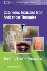 Cutaneous Toxicities from Anticancer Therapies