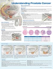 Understanding Prostate Cancer Anatomical Chart