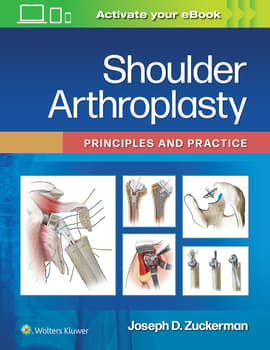 Shoulder Arthroplasty