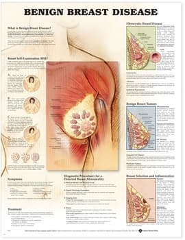 Benign Breast Disease Anatomical Chart