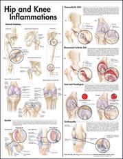 Hip and Knee Inflammations Anatomical Chart