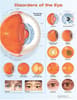 Disorders of the Eye Anatomical Chart