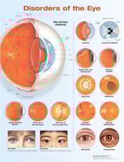 Disorders of the Eye Anatomical Chart