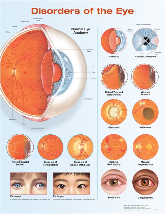 Disorders of the Eye Anatomical Chart