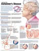 Understanding Alzheimer's Disease Anatomical Chart
