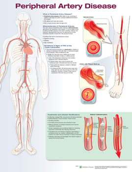 Peripheral Artery Disease Anatomical Chart