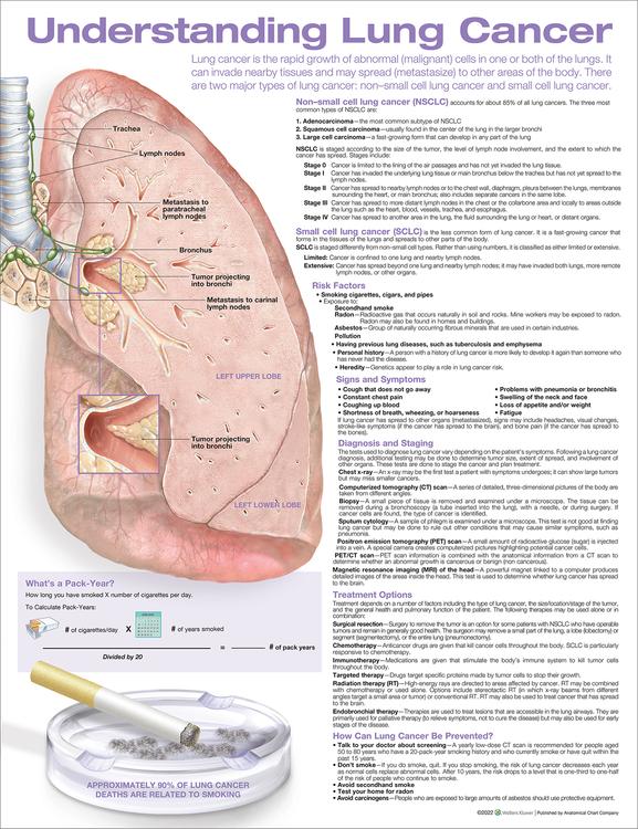 Understanding Lung Cancer Anatomical Chart