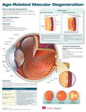Age-Related Macular Degeneration Anatomical Chart