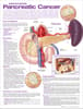 Understanding Pancreatic Cancer Anatomical Chart