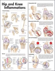 Hip and Knee Inflammations Anatomical Chart