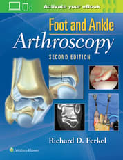 Foot & Ankle Arthroscopy