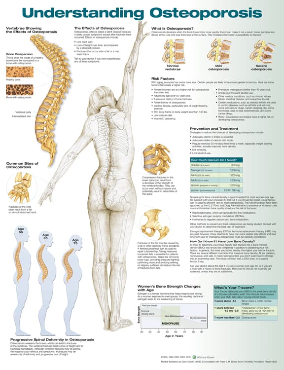 Understanding Osteoporosis Anatomical Chart