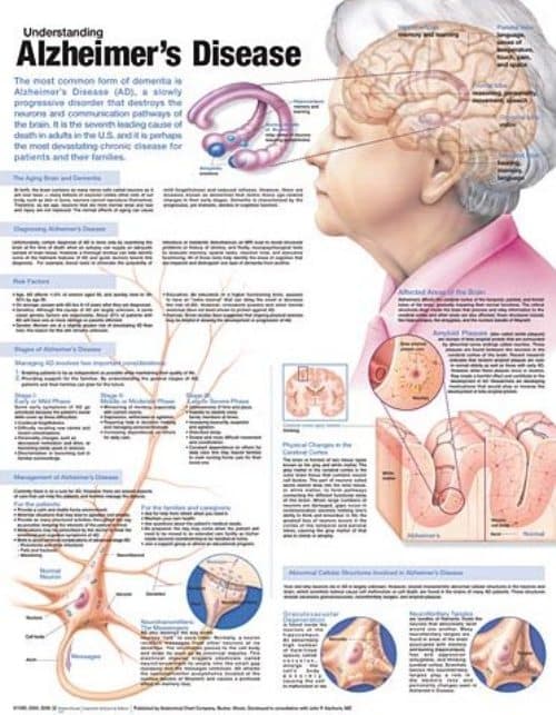 Understanding Alzheimer's Disease Anatomical Chart