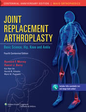 Joint Replacement Arthroplasty