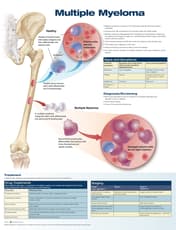 Multiple Myeloma Anatomical Chart