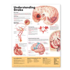 Understanding Stroke Anatomical Chart