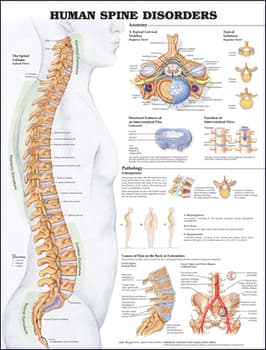 Human Spine Disorders Anatomical Chart