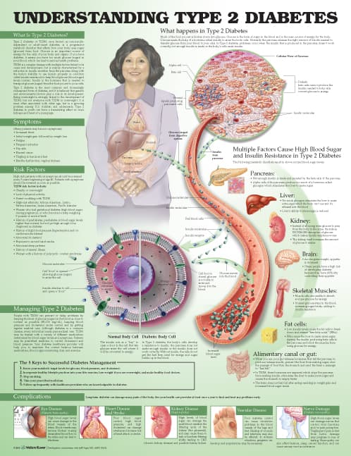 Understanding Type 2 Diabetes Anatomical Chart