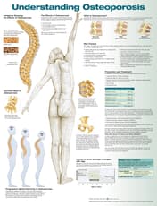 Understanding Osteoporosis Anatomical Chart