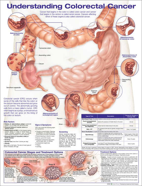 Understanding Colorectal  Cancer Anatomical Chart