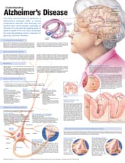 Understanding Alzheimer's Disease Anatomical Chart