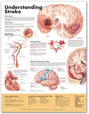 Understanding Stroke Anatomical Chart