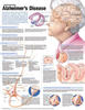 Understanding Alzheimer's Disease Anatomical Chart