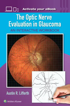 The Optic Nerve Evaluation in Glaucoma