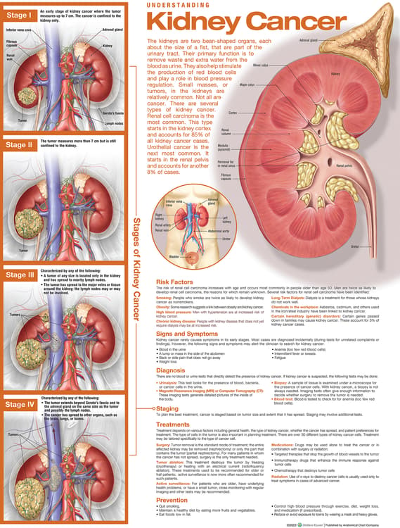 Understanding Kidney Cancer Anatomical Chart