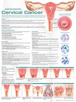 Understanding Cervical Cancer Anatomical Chart