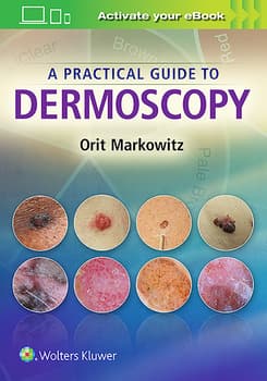 A Practical Guide to Dermoscopy