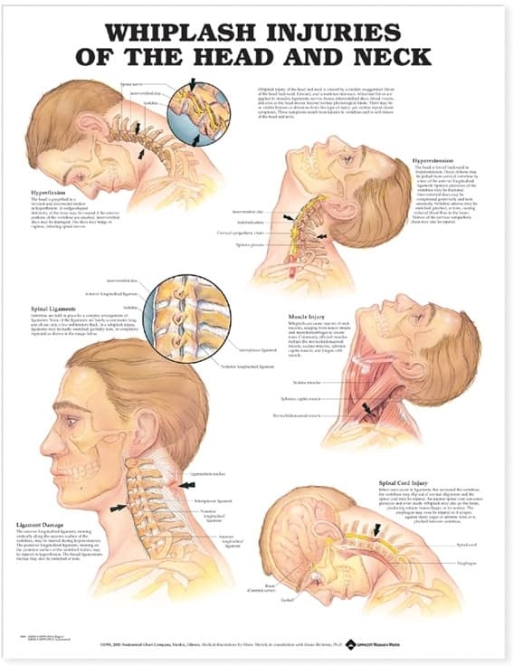 Whiplash Injuries of the Head and Neck Anatomical Chart