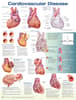 Cardiovascular Disease Anatomical Chart