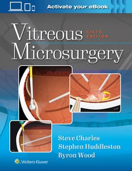 image of Vitreous Microsurgery