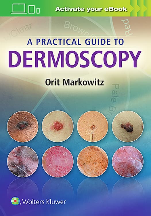 A Practical Guide to Dermoscopy