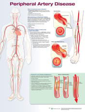 Peripheral Artery Disease Anatomical Chart