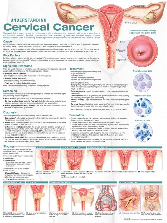 Understanding Cervical Cancer Anatomical Chart
