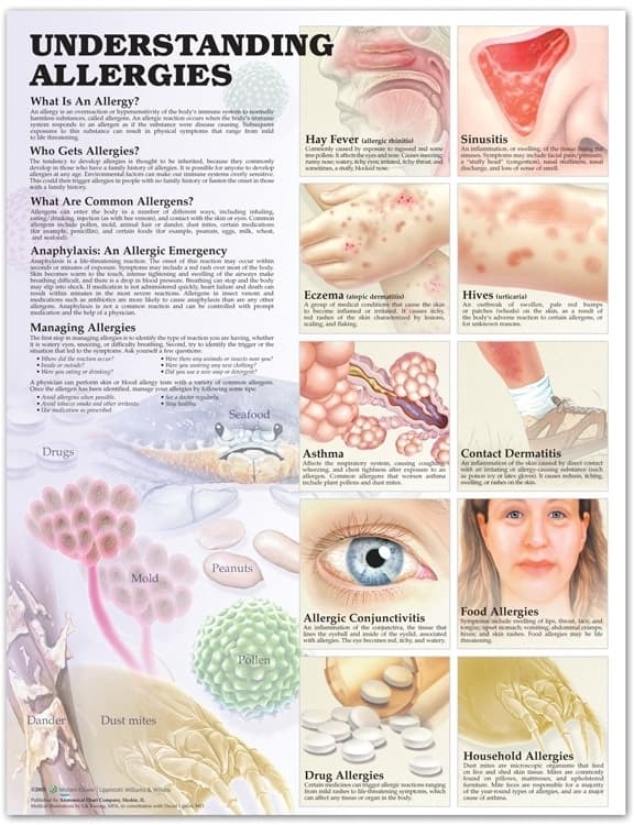 Understanding Allergies Anatomical Chart