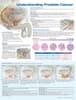 Understanding Prostate Cancer Anatomical Chart