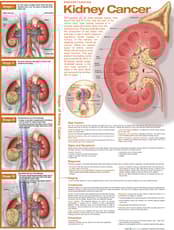 Understanding Kidney Cancer Anatomical Chart