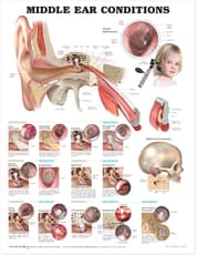 Middle Ear Conditions Anatomical Chart