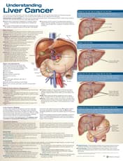 Understanding Liver Cancer Anatomical Chart